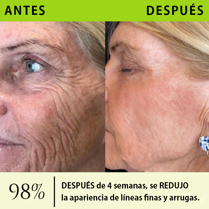 Vosxu™ Botox & Vita-A Retinol Shot sérum lifting antiarrugas ✨ – 💉 Microagujas | 💪 Péptidos con efecto botox | 🌿 Retinol | ⚡ Resultados visibles en 3 días 💎