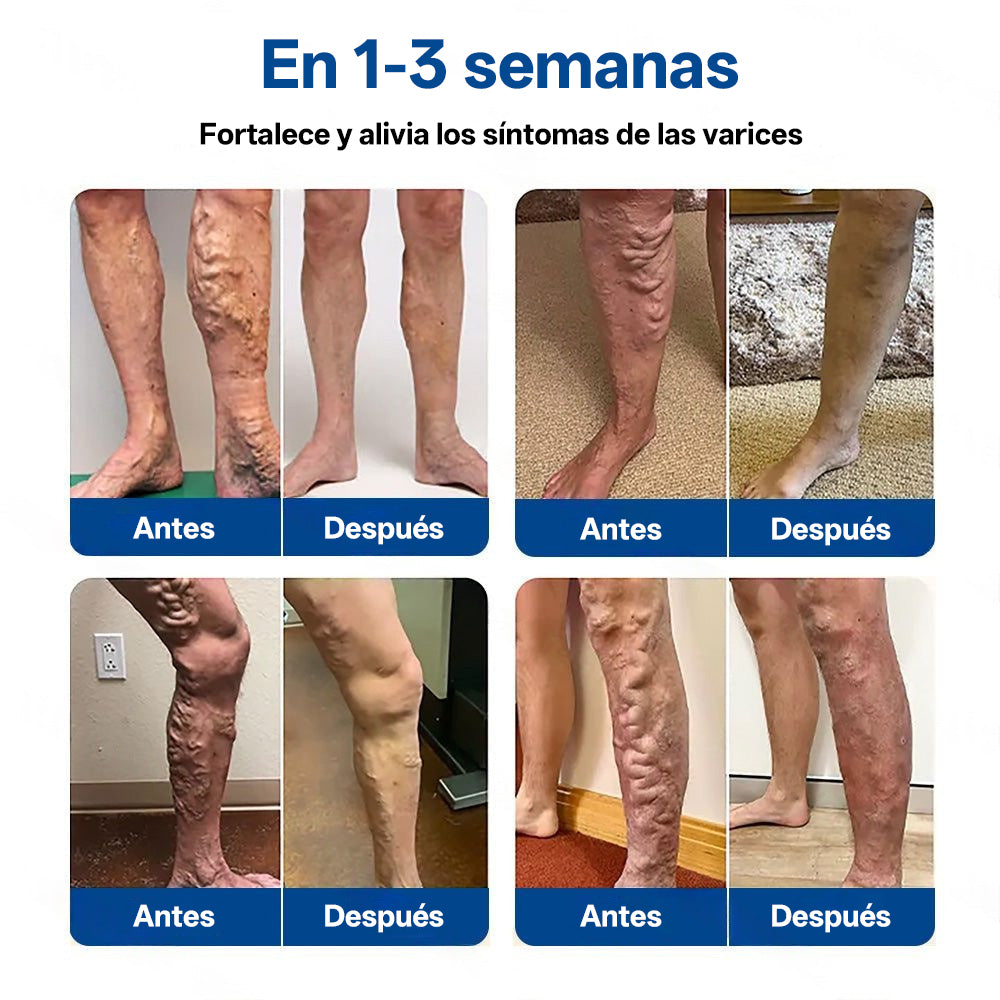 Tainun® VeinTarget Parche de Microagujas Herbal para las Venas 🌿 El primer parche de microagujas con hierbas alpinas certificado por la Unión Europea 🇪🇺 Clínicamente probado con una tasa de éxito de hasta el 96% 📊 Resultados visibles en 7–14 días 🔥🔥
