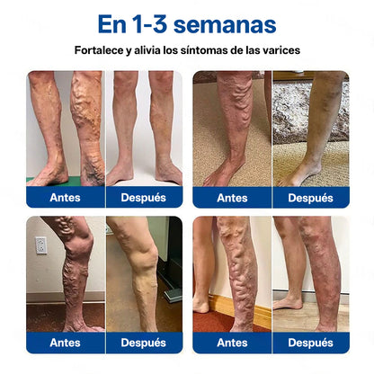 Tainun® VeinTarget Parche de Microagujas Herbal para las Venas 🌿 El primer parche de microagujas con hierbas alpinas certificado por la Unión Europea 🇪🇺 Clínicamente probado con una tasa de éxito de hasta el 96% 📊 Resultados visibles en 7–14 días 🔥🔥