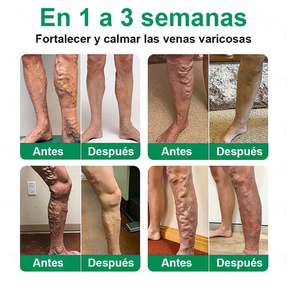 Twisma® VeinTarget – parche avanzado con microtecnología para varices 🦵🔥 Resultados visibles en solo 7–14 días  ⚡ 96 % de eficacia clínicamente comprobada 🌿 Efecto de apoyo suave para piernas más ligeras y relajadas 💪